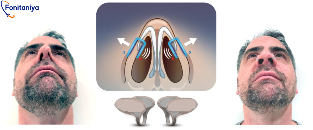 Internal dilator How-it-works
