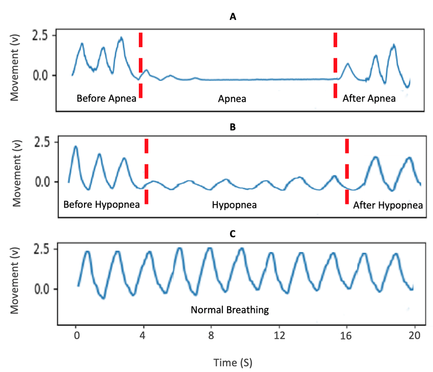 cpap helps back to normal breathing