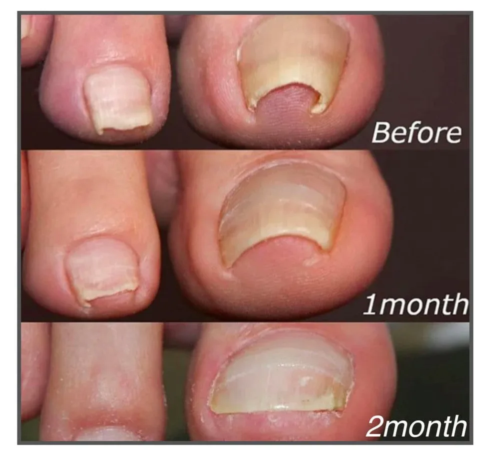 comparison of the condition of toenails using toenail correciton patch